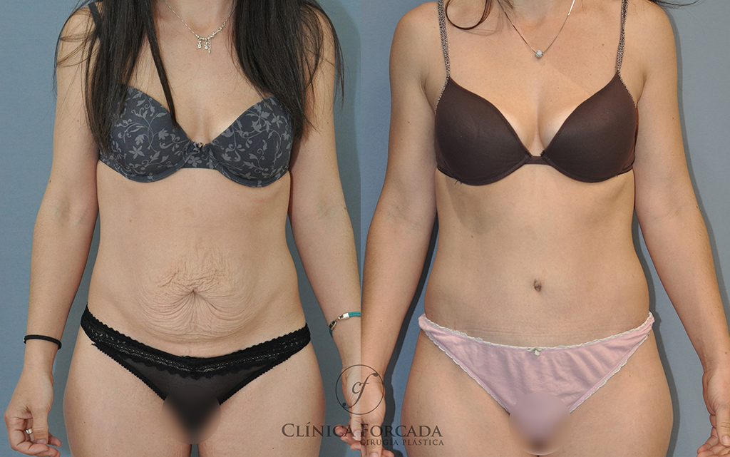 Abdominoplastia sin drenajes Clinica Forcada